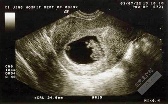 卵巢妊娠的诊断标准 卵巢异位妊娠该如何处理？