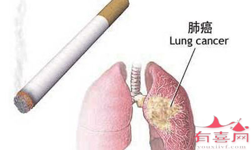烟台助孕信息：大多数肺癌的原因是什么，一文中。