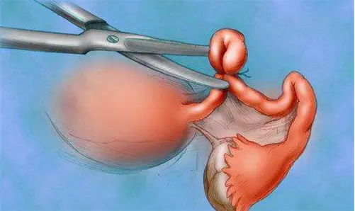 济宁供卵试管助孕生男孩：做过结扎手术的妇女如何仍能怀孕